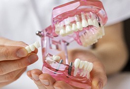 a dentist demonstrating how an implant bridge works with a model of a mouth