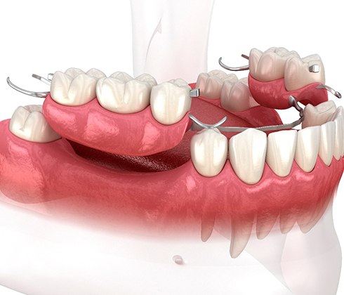 3D graphic of partial dentures 