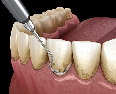 Illustration of scaling and root planing for gum disease treatment in Midlothian