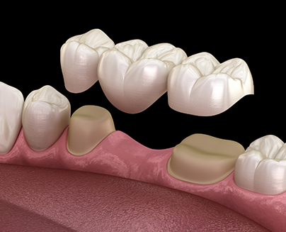 Illustration of dental bridge being attached to prepared teeth