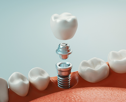 Illustration of dental implant and crown being placed