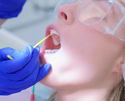 Applying fluoride to patient's upper teeth