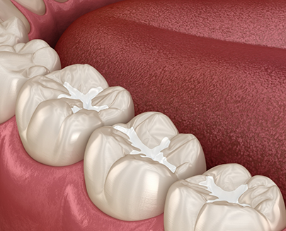 Illustration of teeth with dental sealants