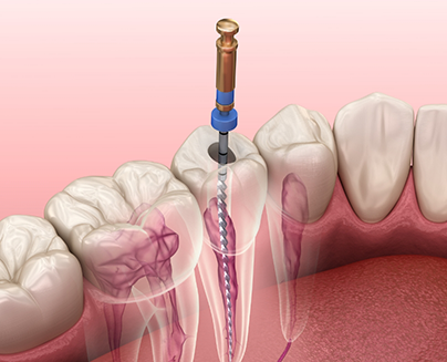 Illustration of root canal treatment in Midlothian for lower arch