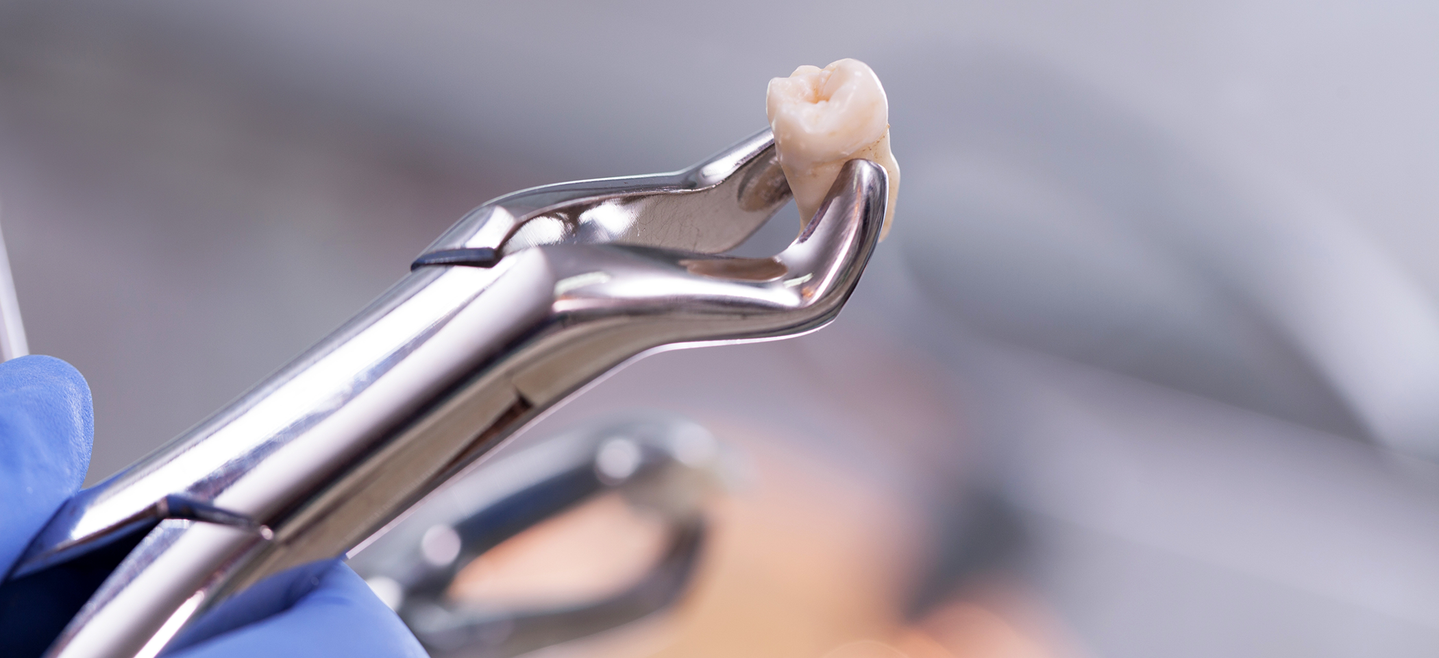 Close-up of forceps holding tooth after a tooth extraction in Midlothian