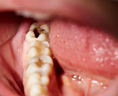 Close-up of decayed tooth in lower arch of mouth