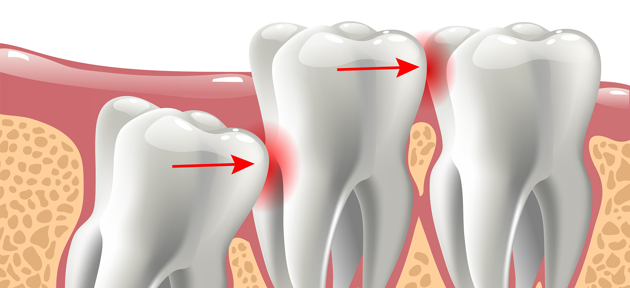 Illustration of impacted wisdom tooth pushing other teeth